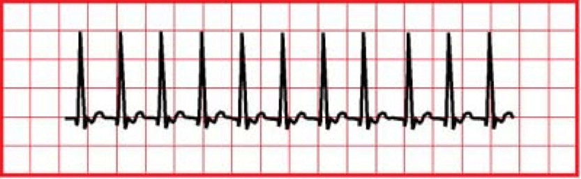 Supraventricular Tachycardia (SVT)