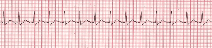 Sinus tachycardia