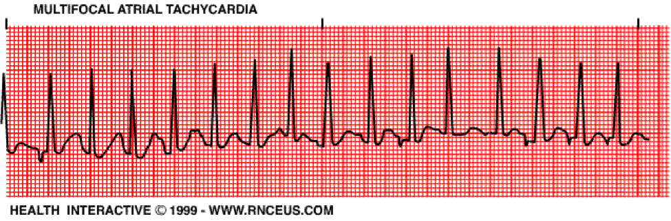 Multifocal Atrial Tachycardia