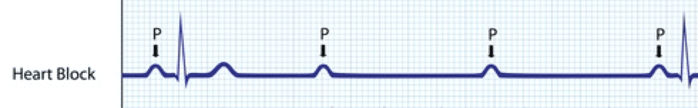 P Wave Electrocardiogram frequency for heart block