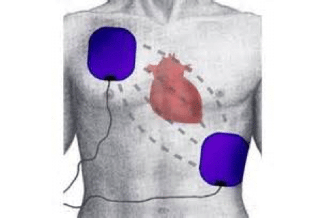 A visual representation of how to use AED Pads