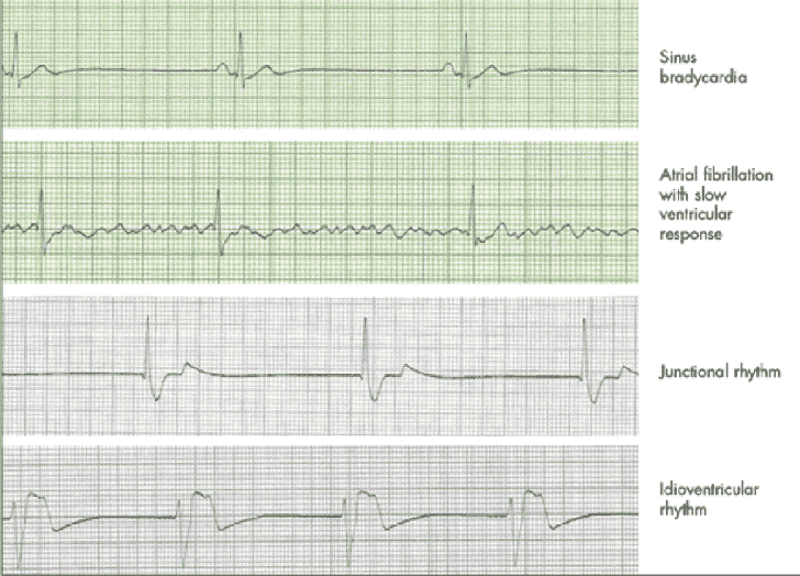 pulseless electrical activity ecg