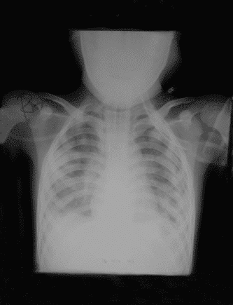 Respiratory First Aid