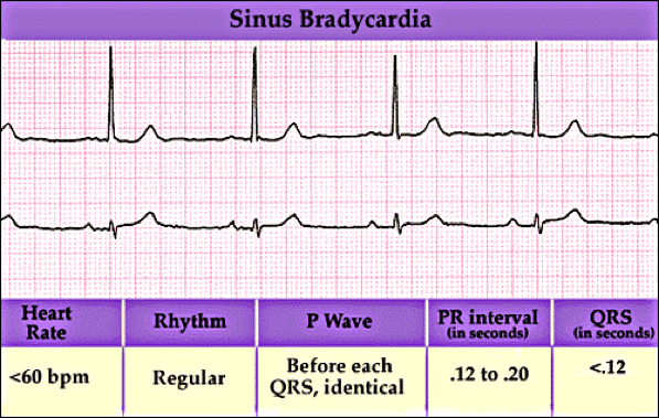 Electrocardiogram frequency for Second Degree AV Block 
