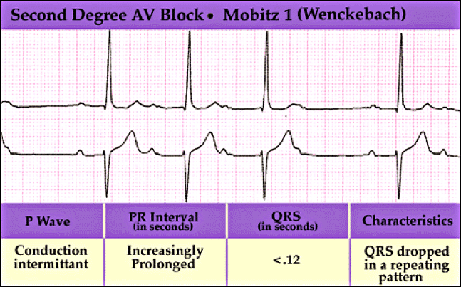ECG tracing showing second-degree AV block Mobitz type I (Wenckebach) with progressively lengthening PR intervals and occasional dropped QRS complexes in a repeating pattern.