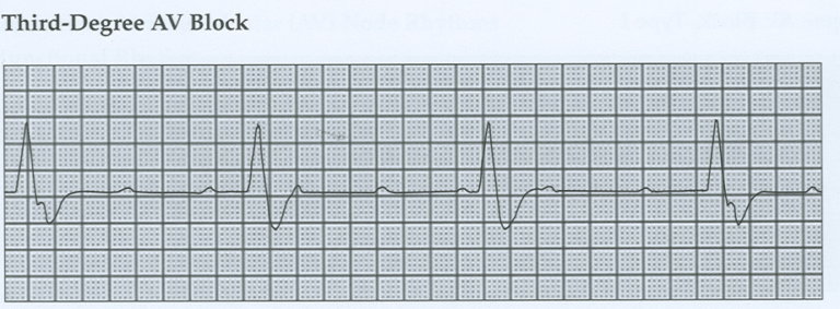 ECG strip showing third-degree AV block with complete AV dissociation and irregular rhythm